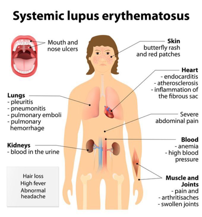 Systemic lupus erythemaosus