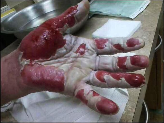 Hand burns 