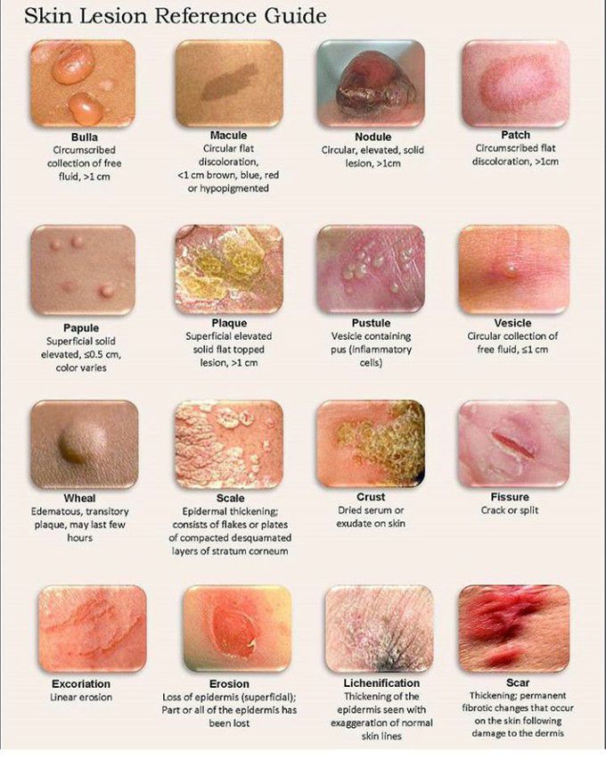 Skin lesion