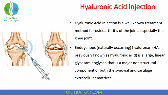 Hyaluronic Acid Injection • Easy Explained - OrthoFixar 2022