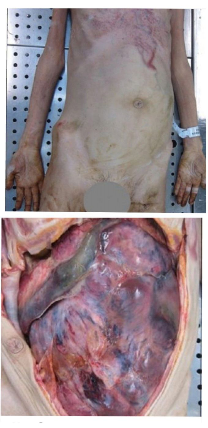 Autopsy of Cancer Patient