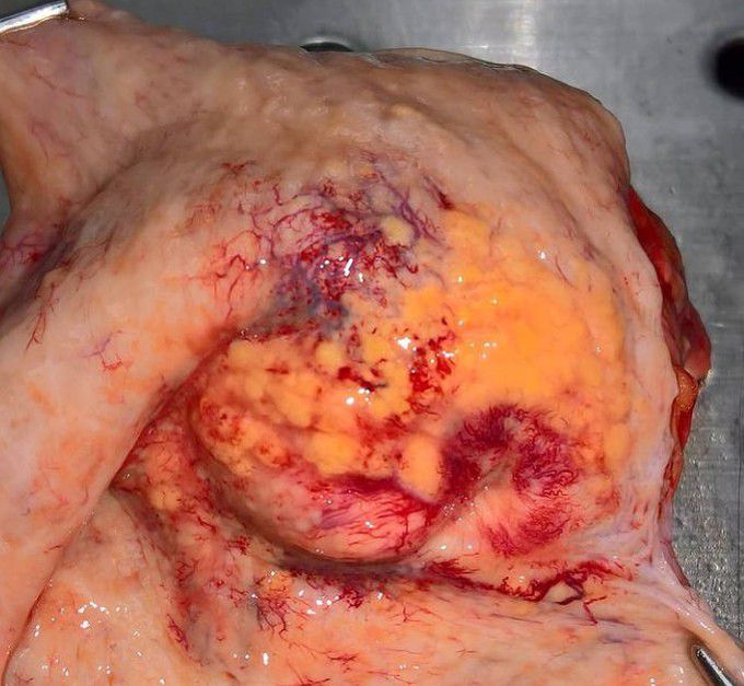 Prostate cancer spreading to the urinary bladder