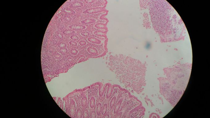 Apendicitis
