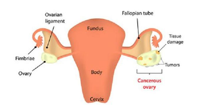 Treatment of pelvic abscess