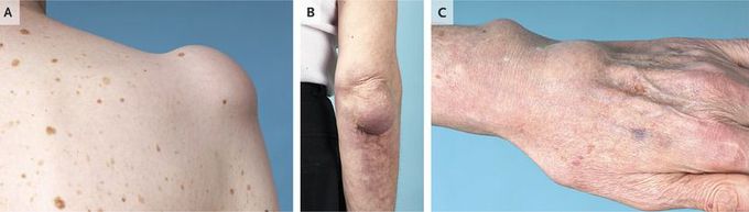 Bursitis and Tenosynovitis Due to Mycobacterium avium Complex