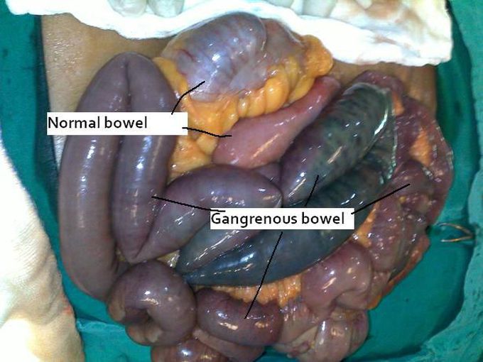 Mesentric ischemia