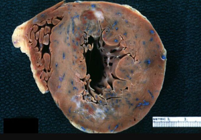 Gross focal myocardial scars and hyperemia chronic ischemic heart disease same as slide 89 but close-up.