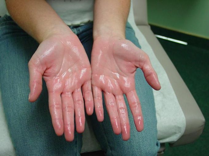 Hyperhidrosis 😨💧💧💧