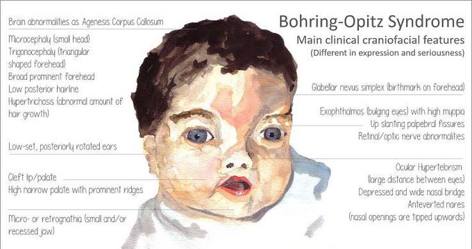 These are the main features of Borhing opitz syndrome