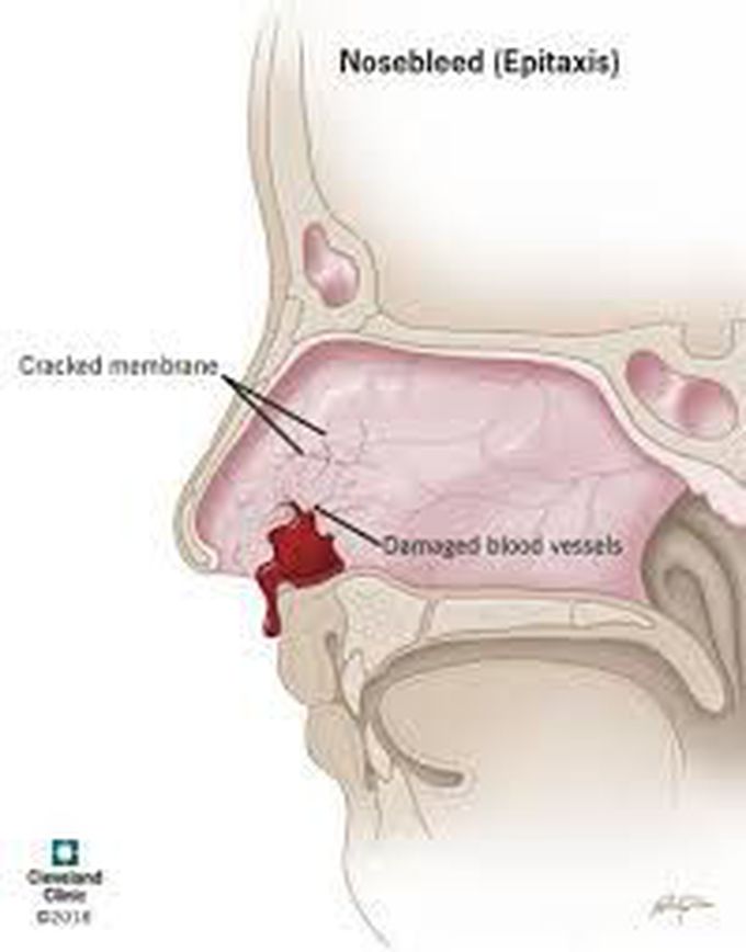 Treatment for epistaxis