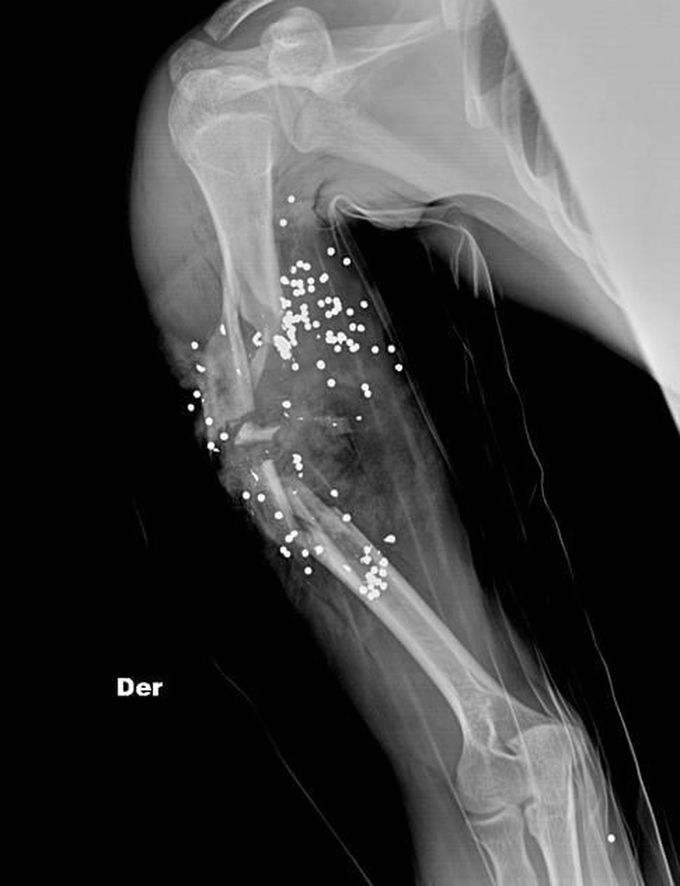 Gun shot wound in humerus