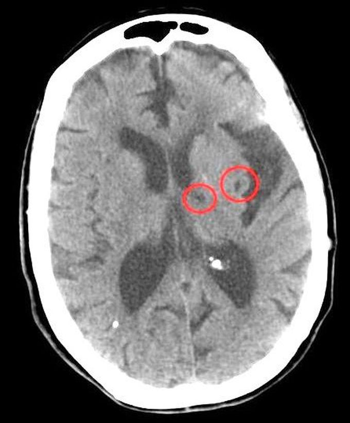 Risk Factors, Signs, and Symptoms of Lacunar Stroke