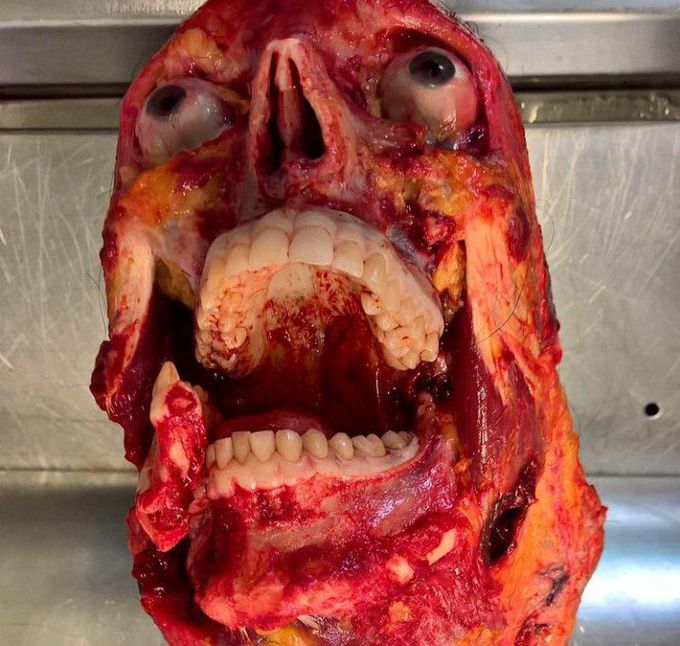 Complex mandibular fracture after traffic accident