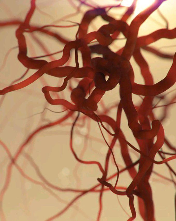 Arteriovenous malformations