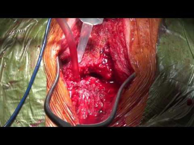 Treatment of Difficult Sternal Nonunion Using the RIA Bone Marrow Harvest System