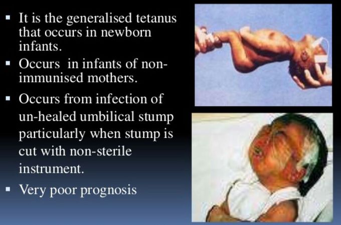 tetanus-neonatorum-medizzy
