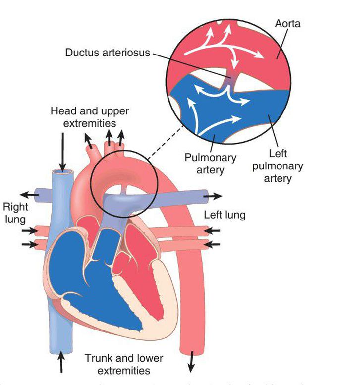 Patent ductus arteriosus