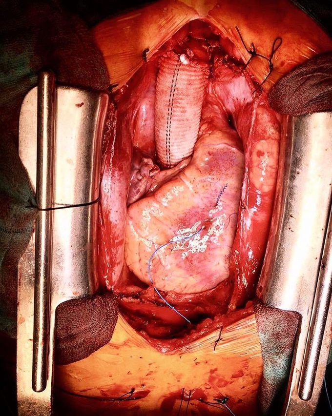 Ascending Aortic Aneurysm surgery