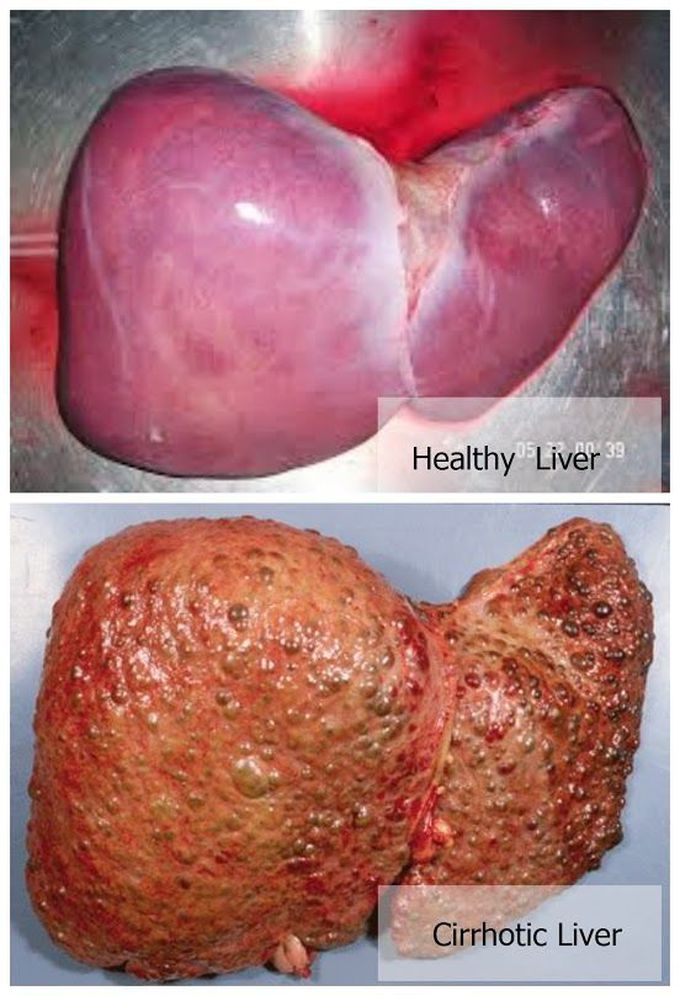 Healthy vs cirrhotic liver