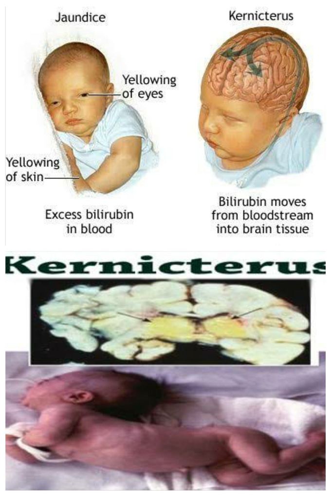 Kernicterus(Bilirubin encephalopathy)