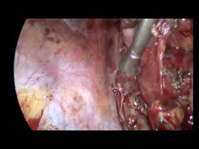 Right VATS Resection of a Complex Mediastinal Bronchogenic Cyst