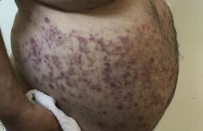 Skin lesion