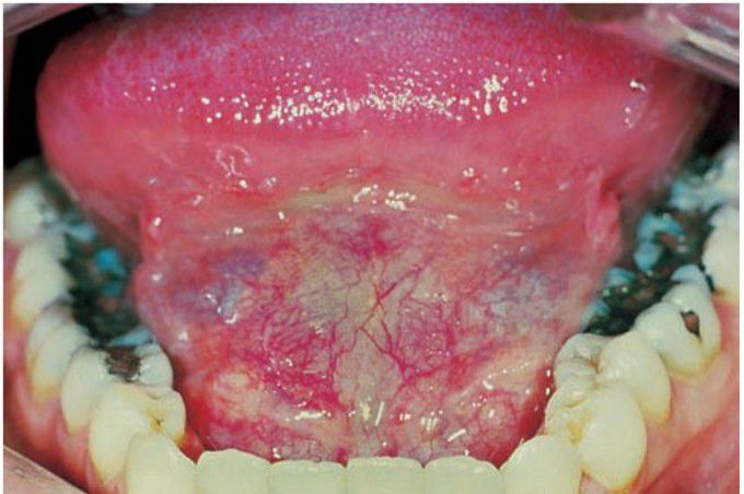 Dermoid cyst