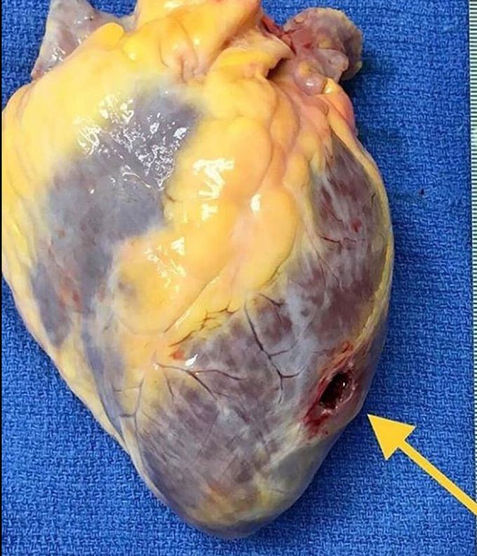 Gunshot 🔫in the left ventricle of the heart 💔