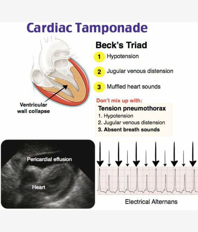 Becks Triad - cardiac tamponade