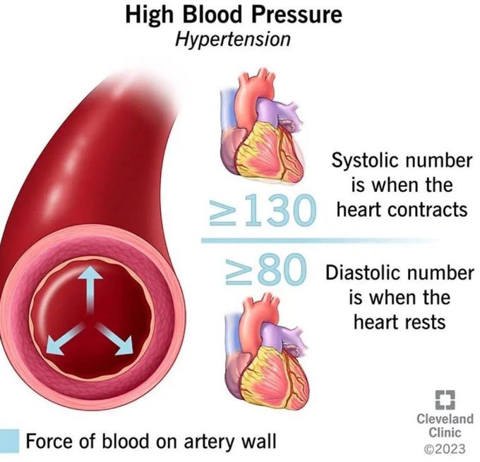 Hypertension