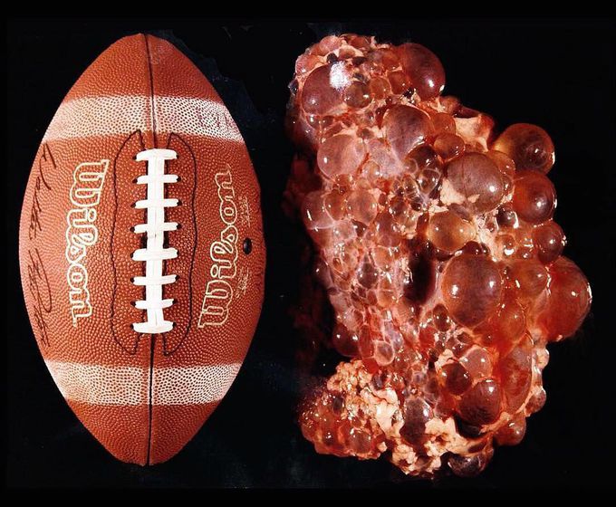 Kidney VS. Football!