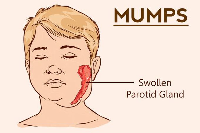 Treatment for Mumps