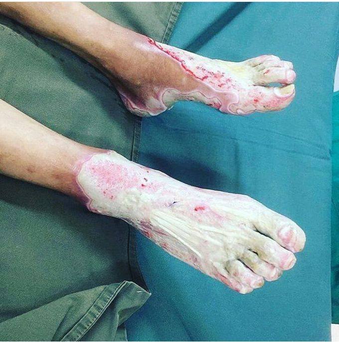 3rd degree burn!!