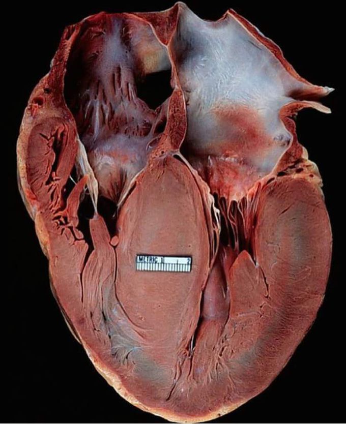 Left ventricular hypertrophy