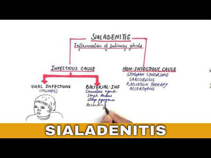Sialadenitis: Bacterial