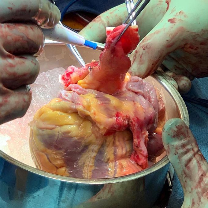 Orthotopic heart transplantations