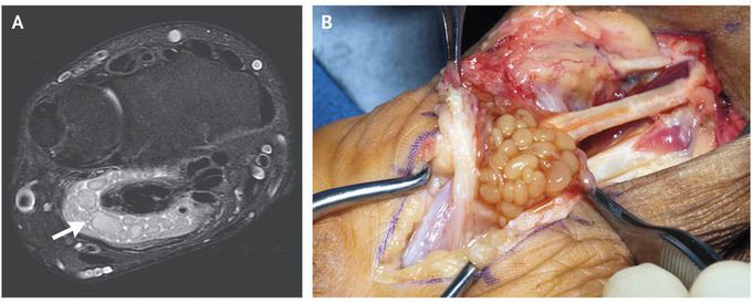 A 51-year-old right-handed man presented to the clinic with a 3-year history of worsening swelling of the left wrist associated with pain and numbness in the fingers. His medical history included type 2 diabetes and human immunodeficiency virus infection; he was adherent to an antiretroviral therapy regimen and his CD4 cell count was 357 per cubic millimeter. He reported no previous trauma or surgeries to the hand. Physical examination was notable for purplish discoloration over the palmar aspect of the left hand. He had pain and an extension deficit in the proximal interphalangeal joint in all four fingers. Magnetic resonance imaging (MRI) revealed multiple loose bodies (“rice bodies”) in an ulnar bursal fluid collection on the volar side of the left wrist (Panel A, arrow). The patient underwent a radical tenosynovectomy, during which soft-tissue masses corresponding to the rice bodies identified on MRI were seen (Panel B). These soft-tissue masses are accumulations of fibrin, collagen, and cell debris resulting from synovial degeneration. Histologic analysis revealed granulomatous tenosynovitis, and mycobacterial culture confirmed invasive mycobacterial tenosynovitis due to Mycobacterium avium complex. The patient was treated with rifabutin, ethambutol, and clarithromycin; the medication regimen was discontinued after 3 months because of side effects. There was no evidence of recurrence at 5-year follow-up