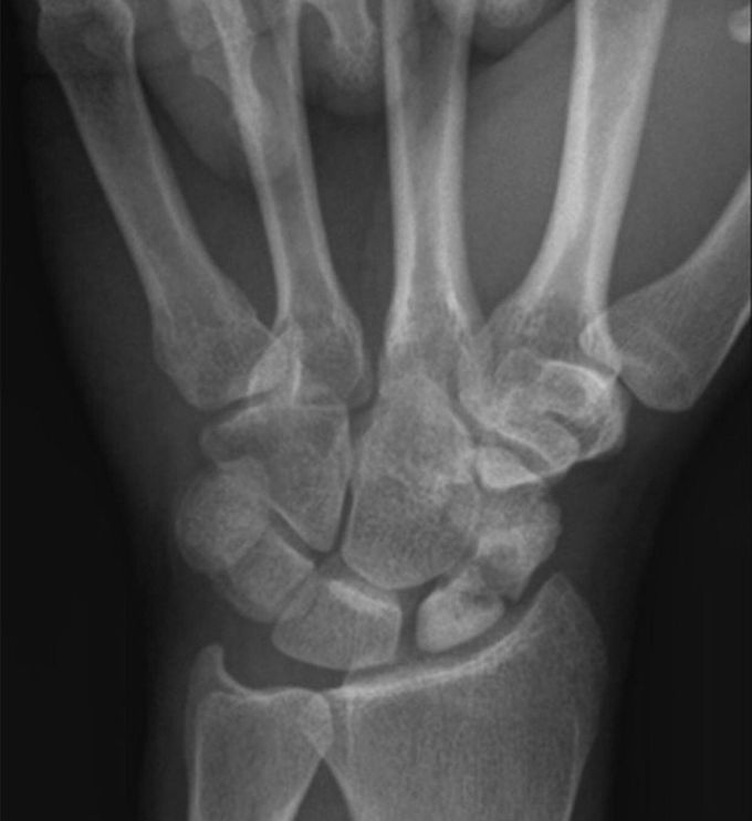 Which bone is fractured in x ray ??