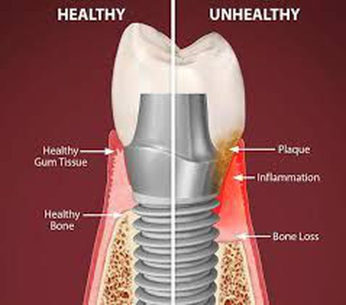 Periimplantitis