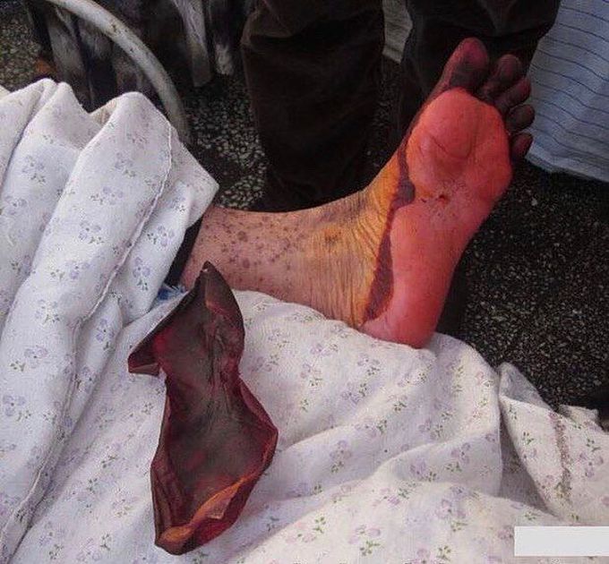 Plantar (heel and sole) foot skin literally peeled off!! 