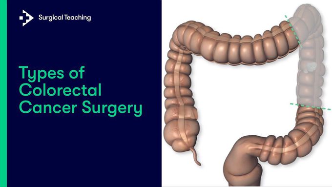 Colorectal Surgery Types: Animation