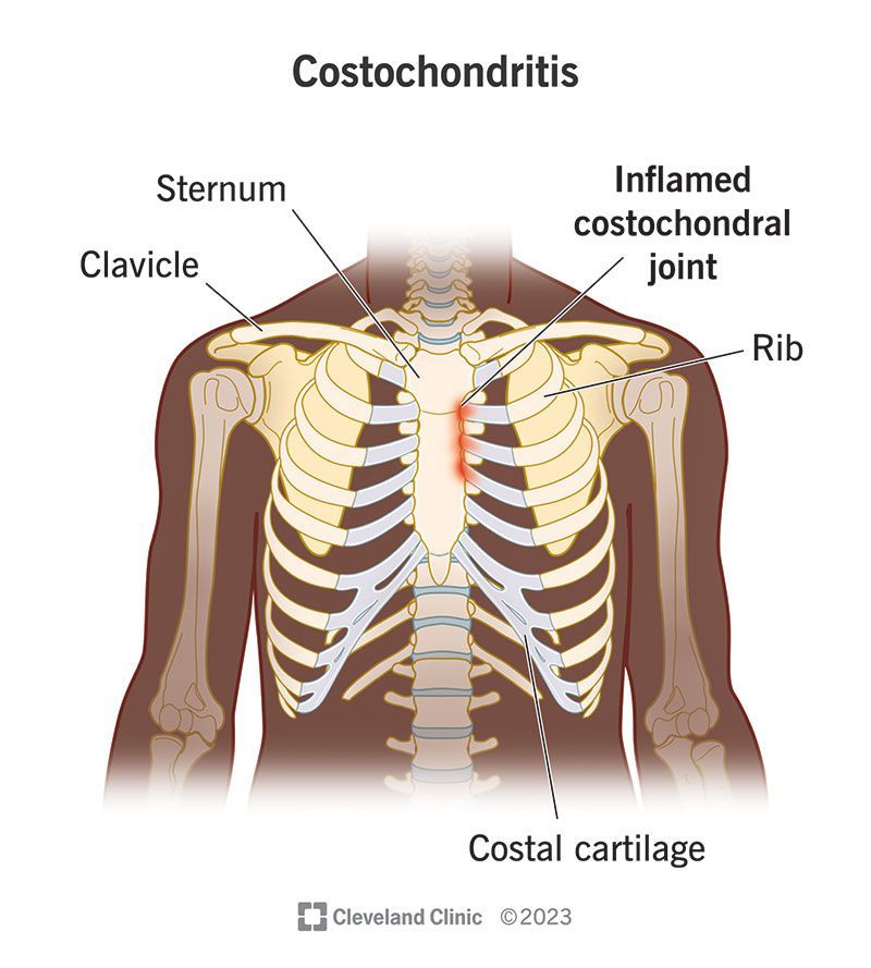 Costochondritis Symptoms Medizzy 0998