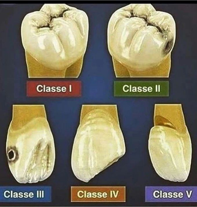 GV Black Classification of Caries