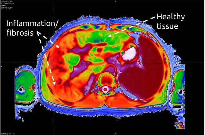 Multiparametric MRI in liver