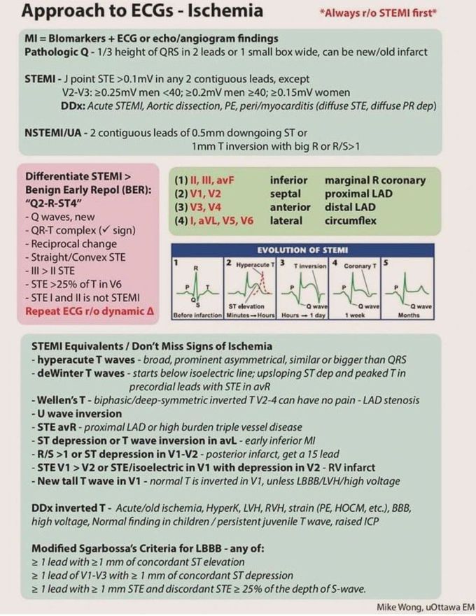 Approach to ECG- Ischemia