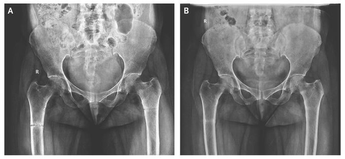 Osteomalacia