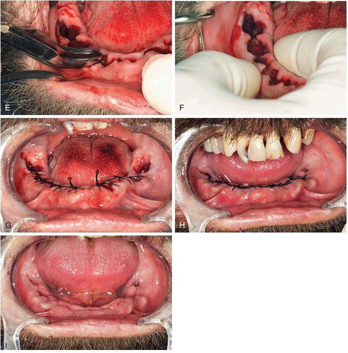 Multiple extractions(cont)