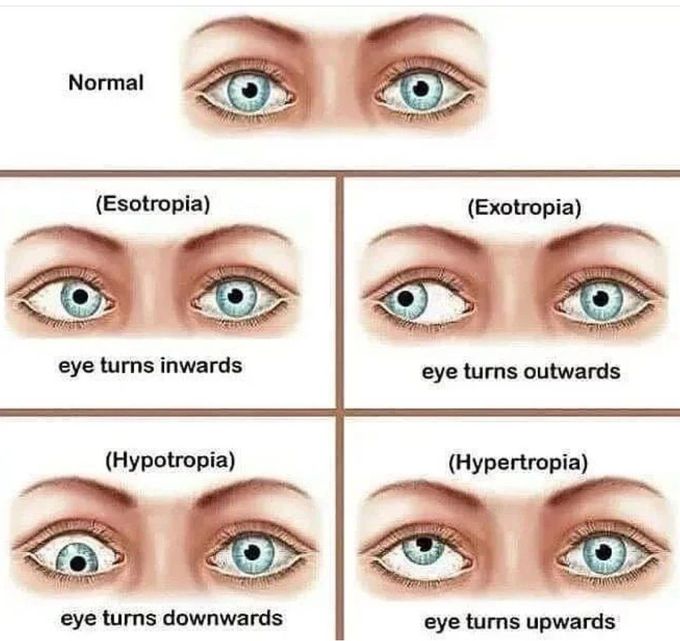 Strabismus