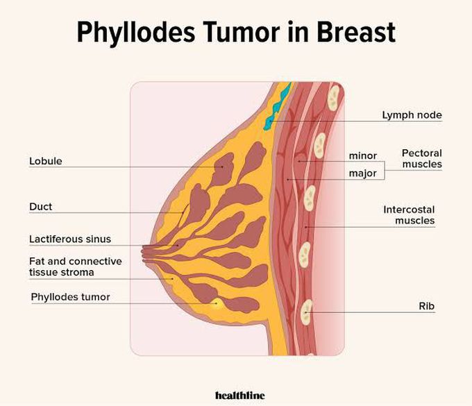 Treatment of phyllodes tumor