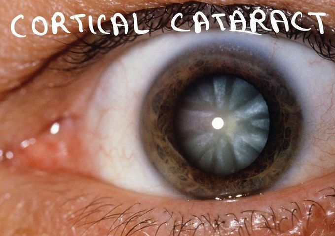 Cortical Cataracts